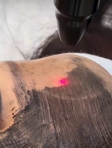 Laser Carbon Peel