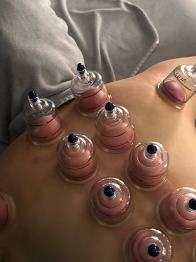 Cupping (Traditional Chinese Therapy)