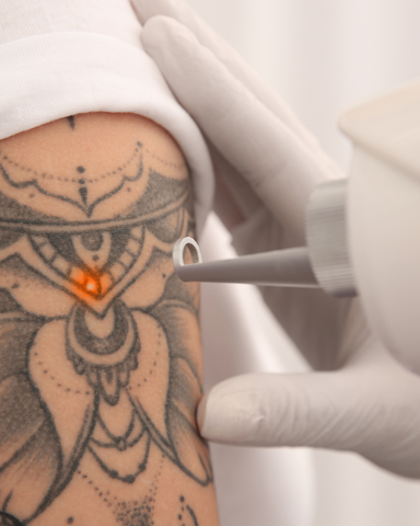 Tattoo Removal (Piqo 4 By Lumenis)