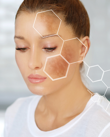 PiQo4 Melasma