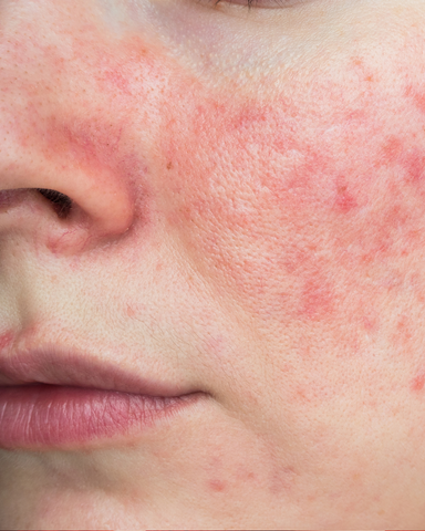 Rosacea