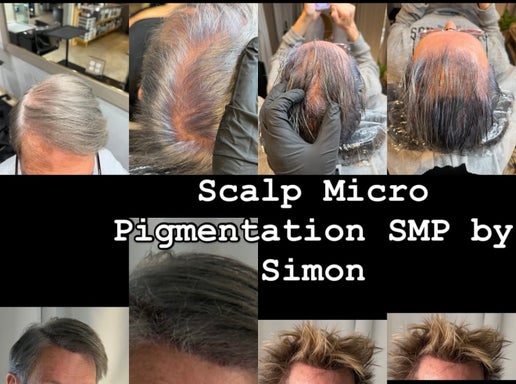 Smp Scalp Micro pigmentation Deposit