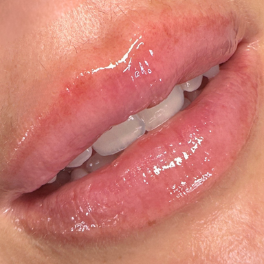 Hyaluronic Lip Renewal - Package of 4 Treatments
