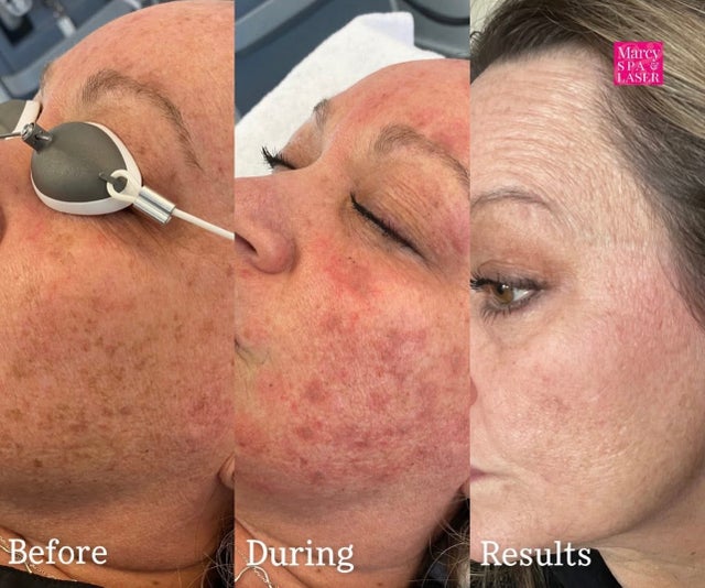 Laser Pigmentation Services