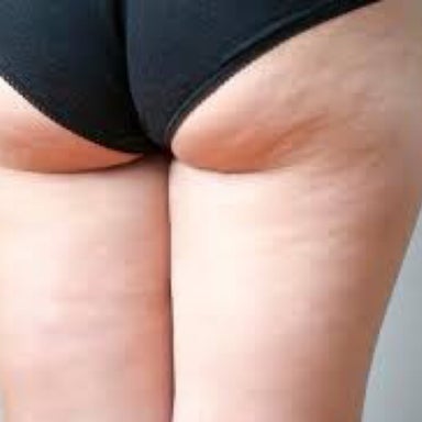 Legs Cellulite Reduction
