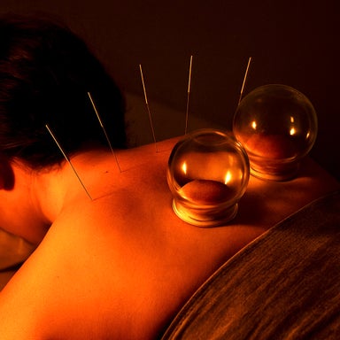 Acupuncture and Cupping – Deep Relief and Circulation Reset