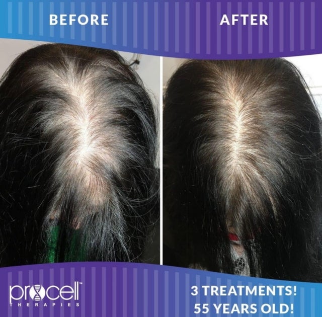 Procell Therapies Hair Follicle Rejuvenation