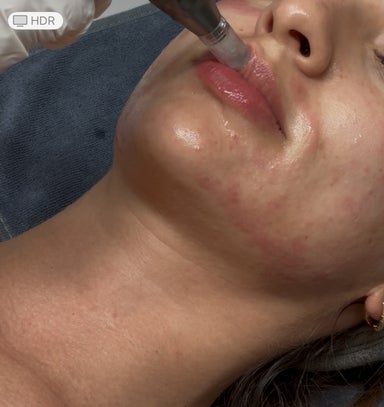 Collagen lip booster With Microneedling