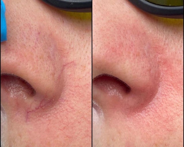 Laser Broken Capillaries Removal
