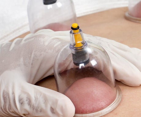 Cupping