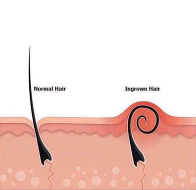 Ingrown Hair Treatment (Add-on service)