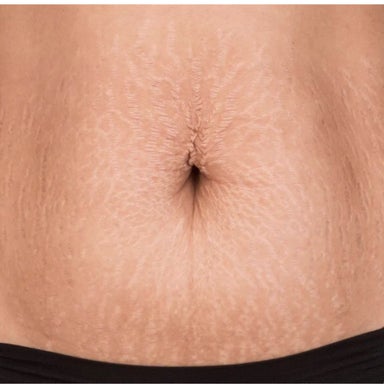 Abdomen Scars/Stretchmarks