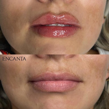 Lip Augmentation