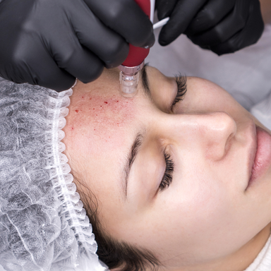 Microneedling