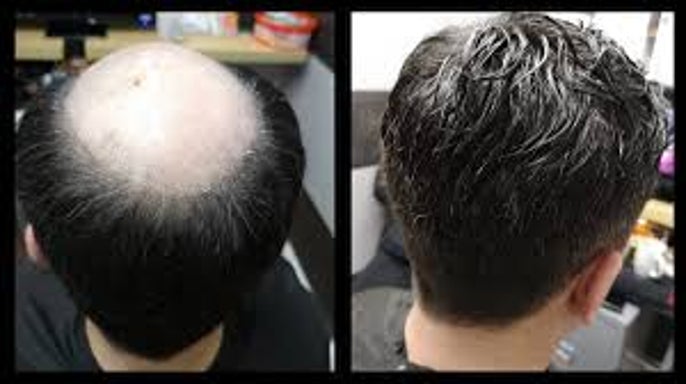 Male Partial Unit Install
