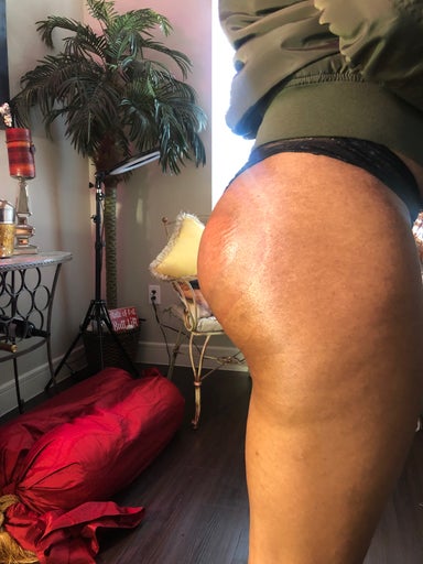 COLOMBIAN BUTT LIFT & CRYO-SKIN THERAPY