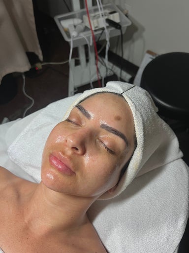 Microdermabrasion