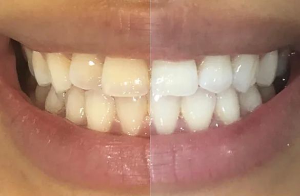 Teeth Whitening