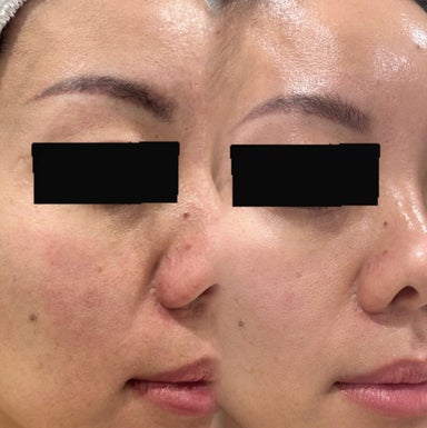 Microneedling Facial with Exosomes & PDRN