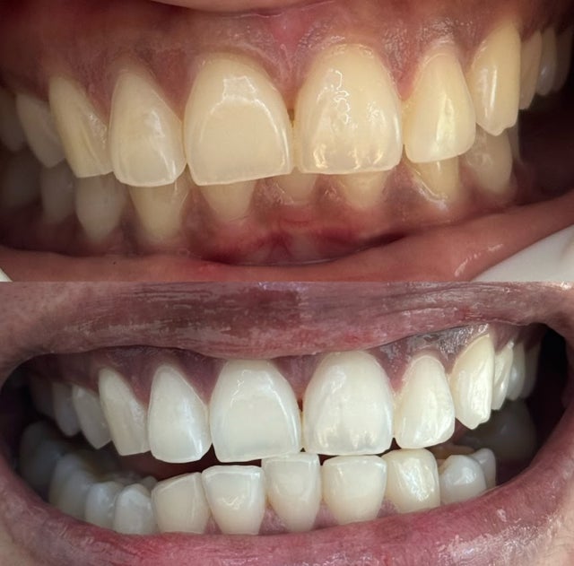 TEETH WHITENING