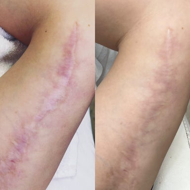 SkinPen Microneeding Extra Body Part (Add on with face)