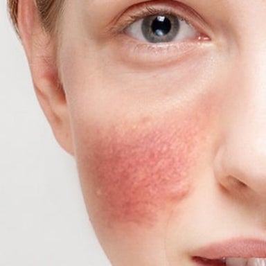 Cryo Face Rosacea