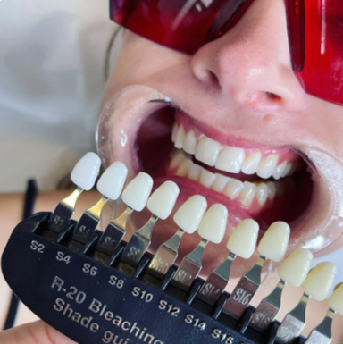 Teeth Whitening
