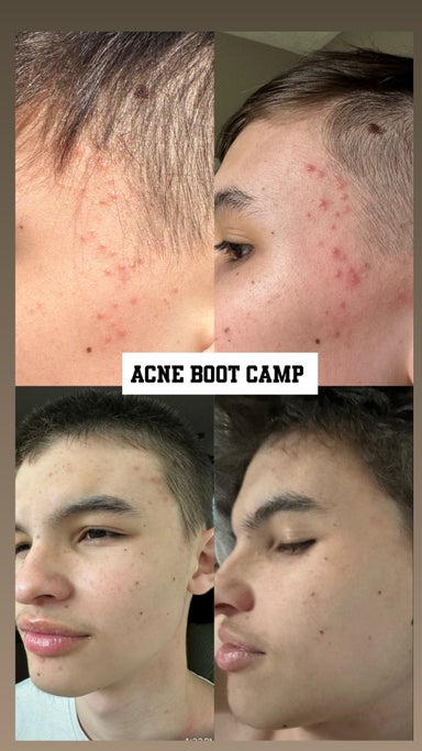 Face Reality Acne Bootcamp