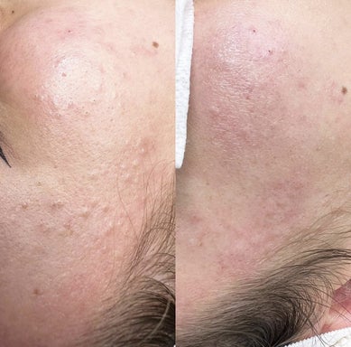 Facial - Acne