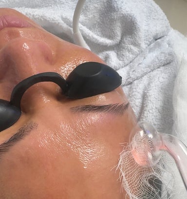 High Frequency Acne Facial