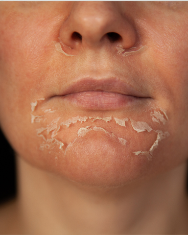 Chemical Peel