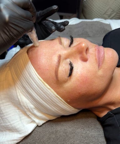 SkinPen Microneedling