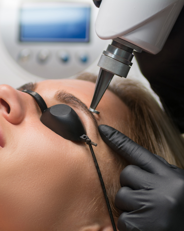 Laser Tattoo Removal