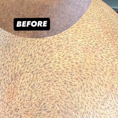 SMP Full scalp