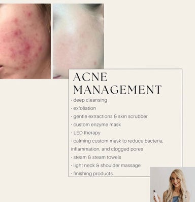 Acne Management Facial