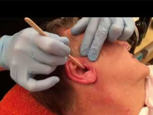 Ear and Nose Wax