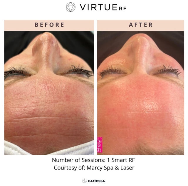 Virtue RF Microneedling