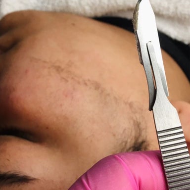 DERMAPLANE ADD ON