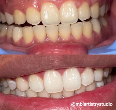 Teeth Whitening (SUMMER PROMO)