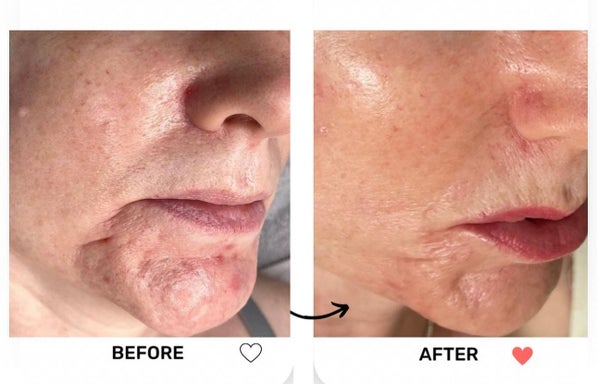 Microneedling Facial with BioRepeel