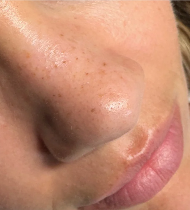 Freckles and Cheeks