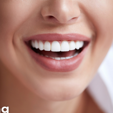 Professional Teeth Whitening - Peroxide Free