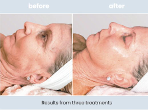 SWiCH Treatment