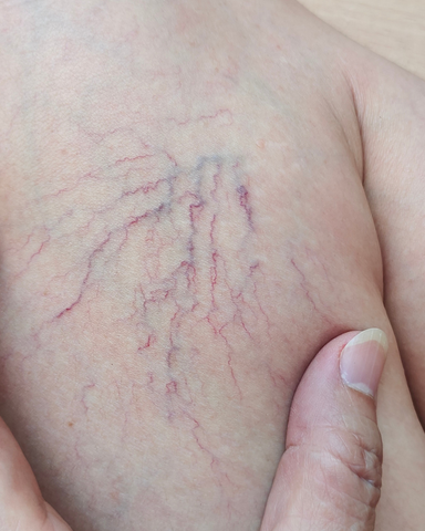 ND-Yag (veins and Telangectasias)