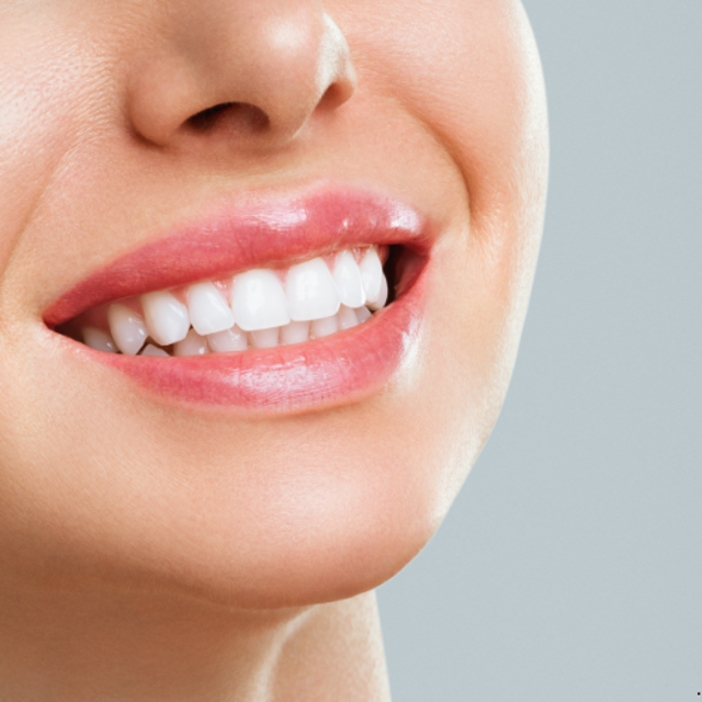 Teeth Whitening