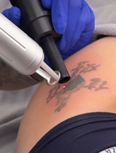 Laser Tattoo Removal Body