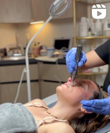 Face and Neck Microneedling Treatment with Korean Serum