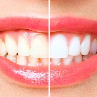 Brightest (24k Gold) Teeth Whitening
