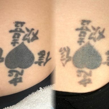 UNLIMITED Laser Tattoo Removal Packages