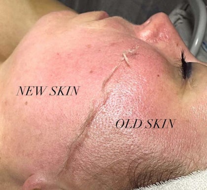 Dermaplane Facial